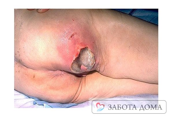 Смерть от пролежней возникает при достаточно запущенных случаях Запущенный пролежень
