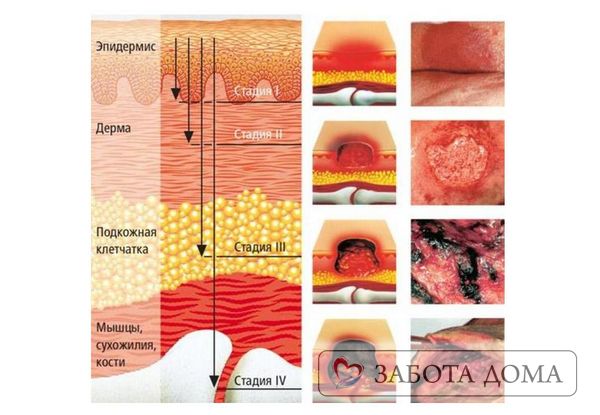Повреждения кожных покровов чрезвычайно болезненны для ослабленного человека – на этом фоне появляются зуд, покалывание и жжение. В некоторых местах образуются ярко-розовые пузыри, в других – тяжело заживающие язвы. Стадии развития пролежней