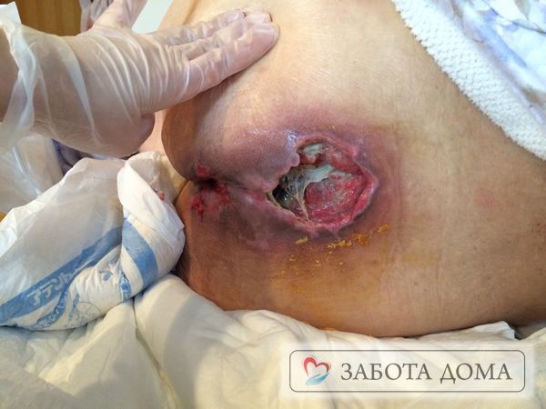 Одним из самых грозных осложнений является омертвление в области крестца глубоких пояснично-крестцовых мышц Опасный пролежень на крестце