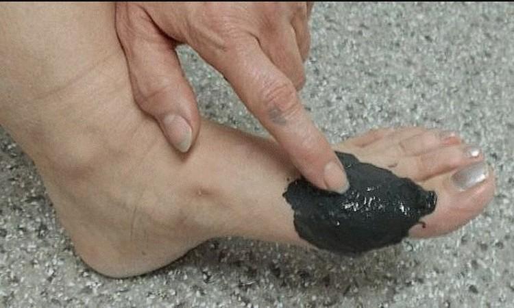 Самыми распространенными методами при подагре являются компрессы