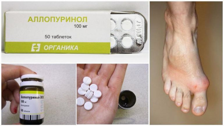 Применение Аллопуринола при подагре