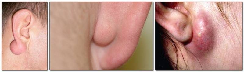Новообразования ушей