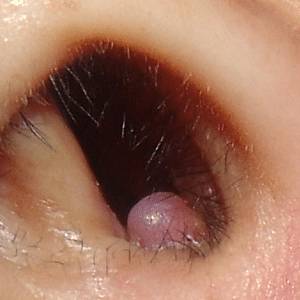 бактерии клебсиелла в носу симптомы