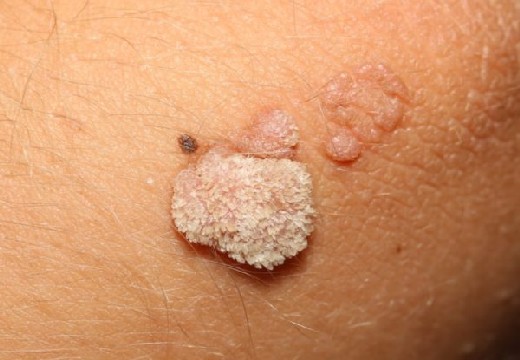 папиллома на теле