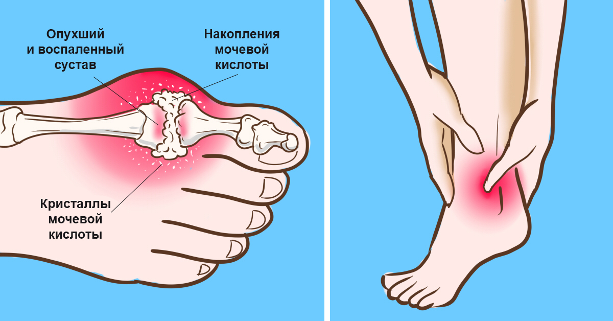 Накопление мочевой кислоты в суставах