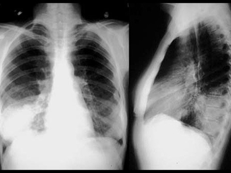 Симптомы пневмонии Признаки пневмонии