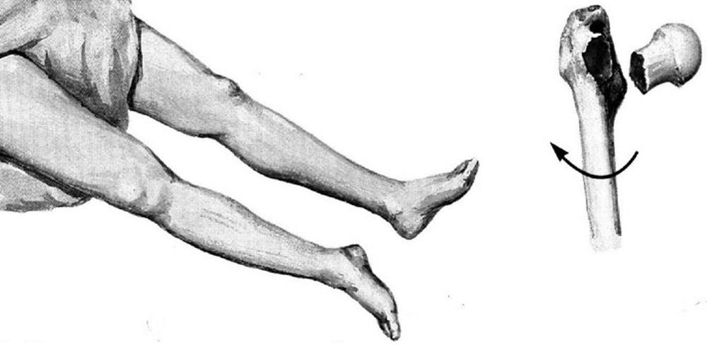 синдром прилипшей пятки синдром прилипшей пятки