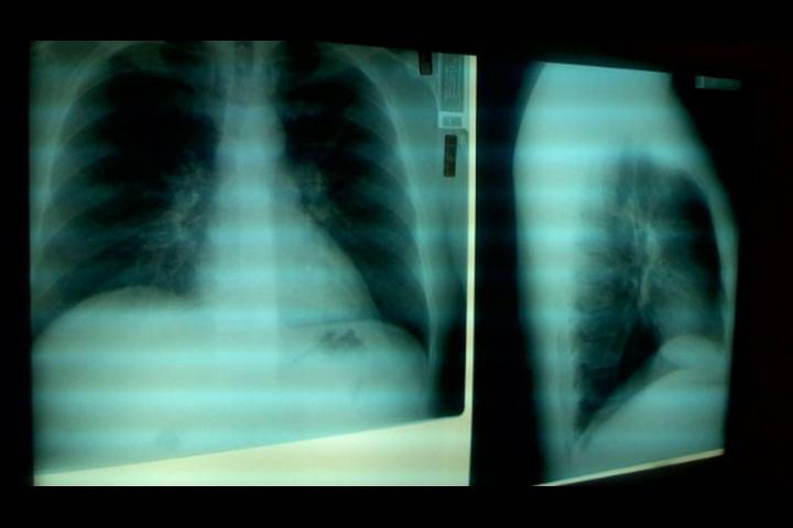 пневмония у пожилых людей прогноз