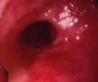 Ожог пищевода Ожог пищевода