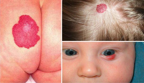 Родимые пятно в виде ожога Родимые пятно в виде ожога thumbnail