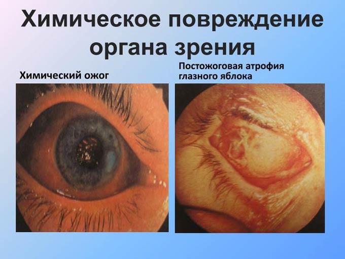 капли от химического ожога глаз