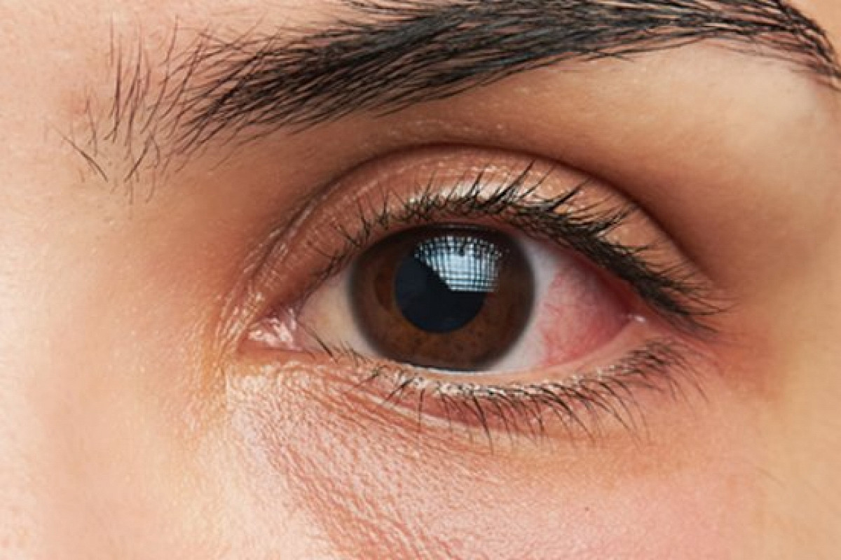 Ожог глазного яблока при наращивании ресниц