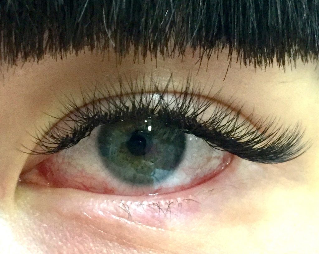 Ожог глазного яблока при наращивании ресниц