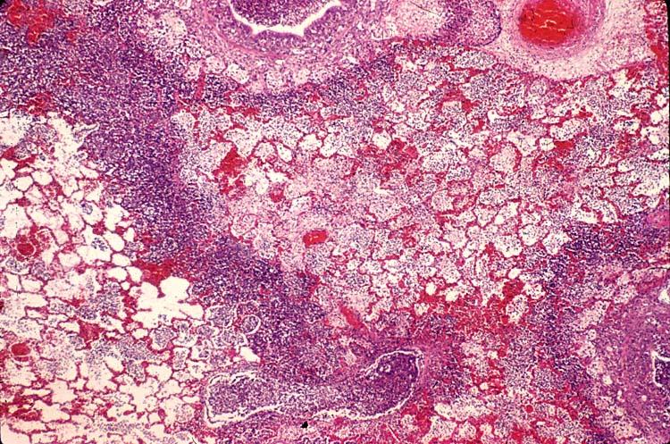 Бронхопневмония