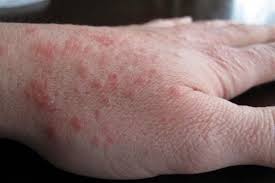 Аллопуринол при подагре механизм действия