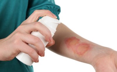 Нужно ли лопать волдырь при ожоге