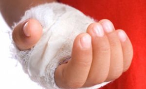 Как вылечить волдыри при ожогах