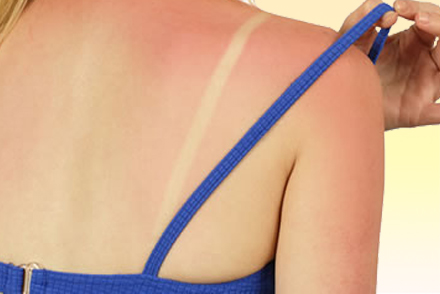 Чувствительная кожа к солнцу Покраснения кожи от солнца