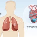 Схема накопления лишней жидкости в легких Схема накопления лишней жидкости в легких