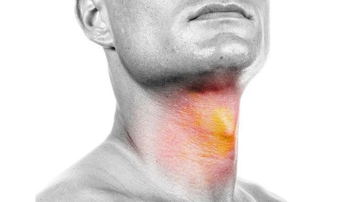 При ожоге слизистой горла что делать