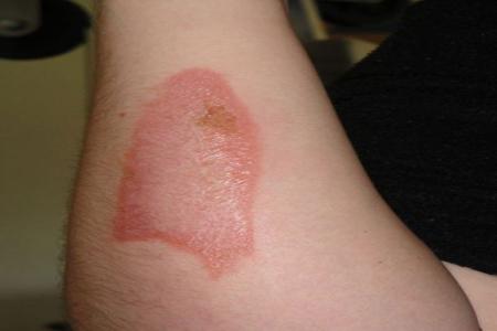 ожог на руке