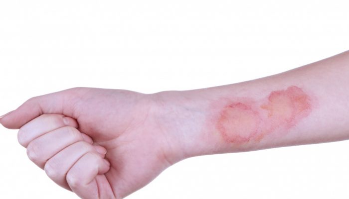 Рана как ожог но не ожог