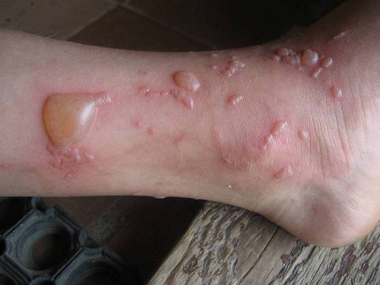 Нужно ли лопать волдырь при ожоге