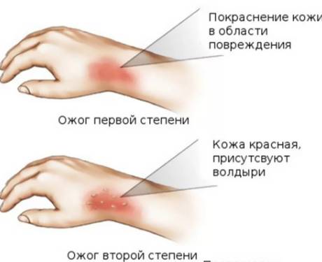 ожоги-2-степени