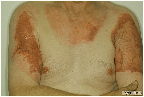 Шрамы рубцы на коже ожоги