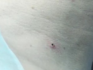 Черная маленькая корочке на месте папилломы, удаленной лазером.