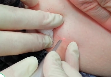 Удаление папилломы лазером в клинике - одна из самых востребованных услуг.