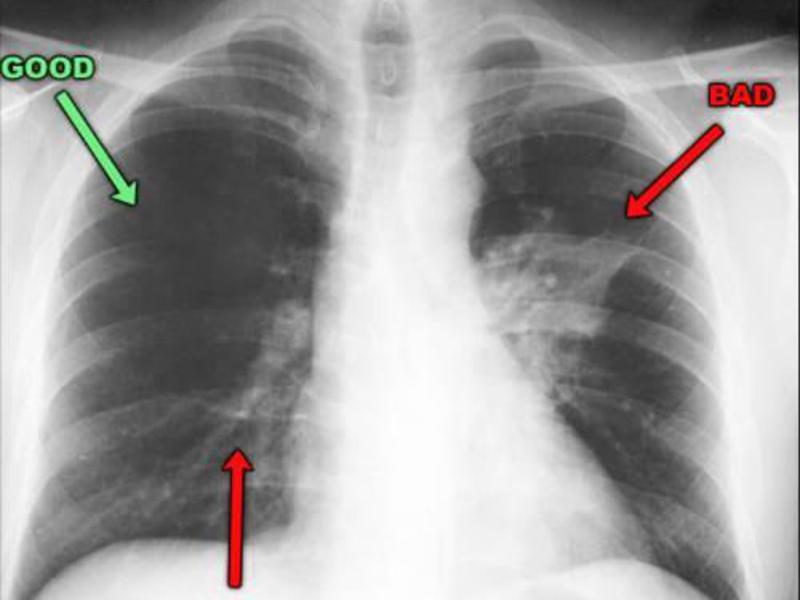 Показатели пневмонии Как проявляется заболевание пневмония