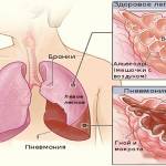 Схема пневмонии Схема пневмонии