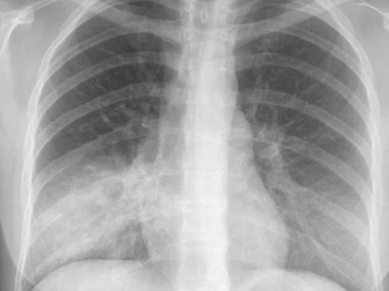 Лечение пневмонии у взрослых Как лечить пневмонию