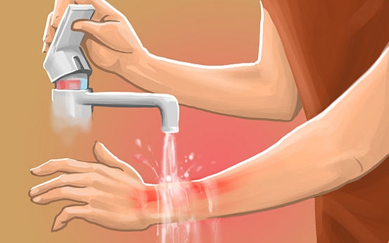 Действия при ожеге