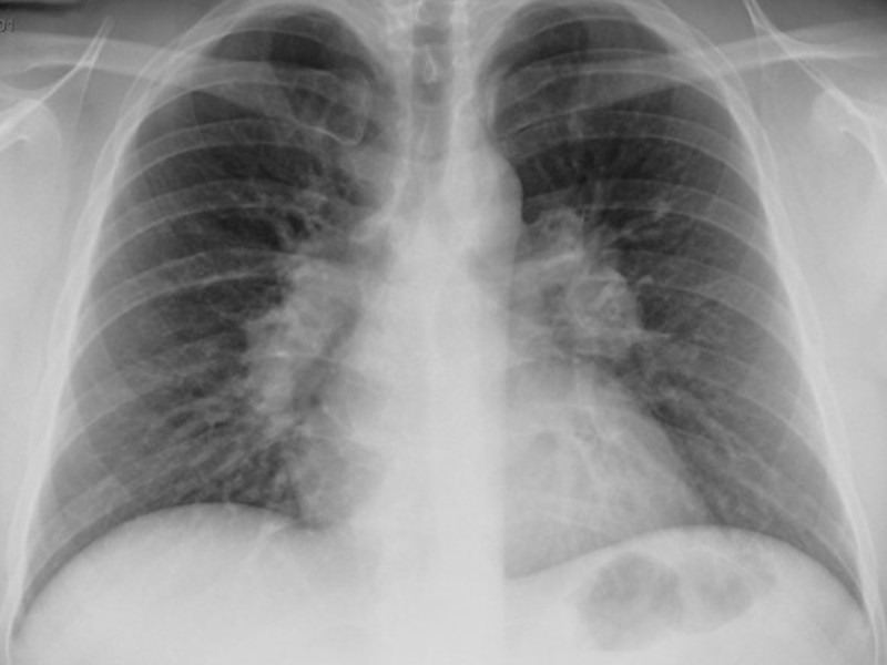 Признаки пневмонии Пневмония на снимке