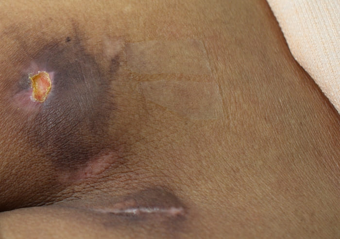 Пролежни и их обработка фото