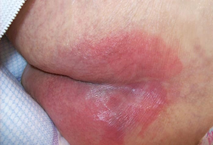 Пролежни и их обработка фото