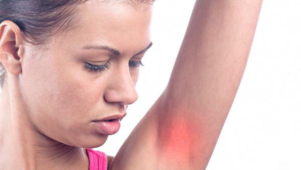 раздражение подмышек раздражение подмышек