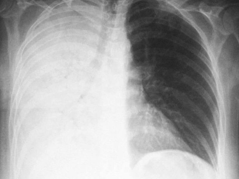 На снимке очаг пневмонии Очаговая пневмония
