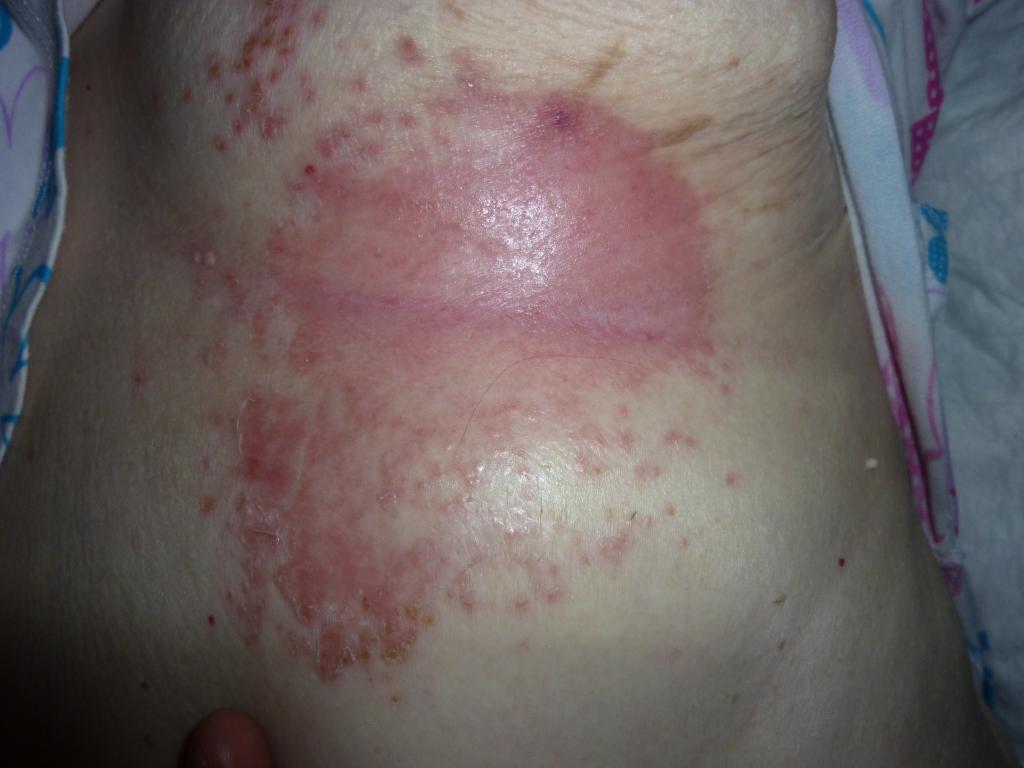 Опрелость. Лежачий больной. Diaper rush. Рис. 3 Опрелость..JPG