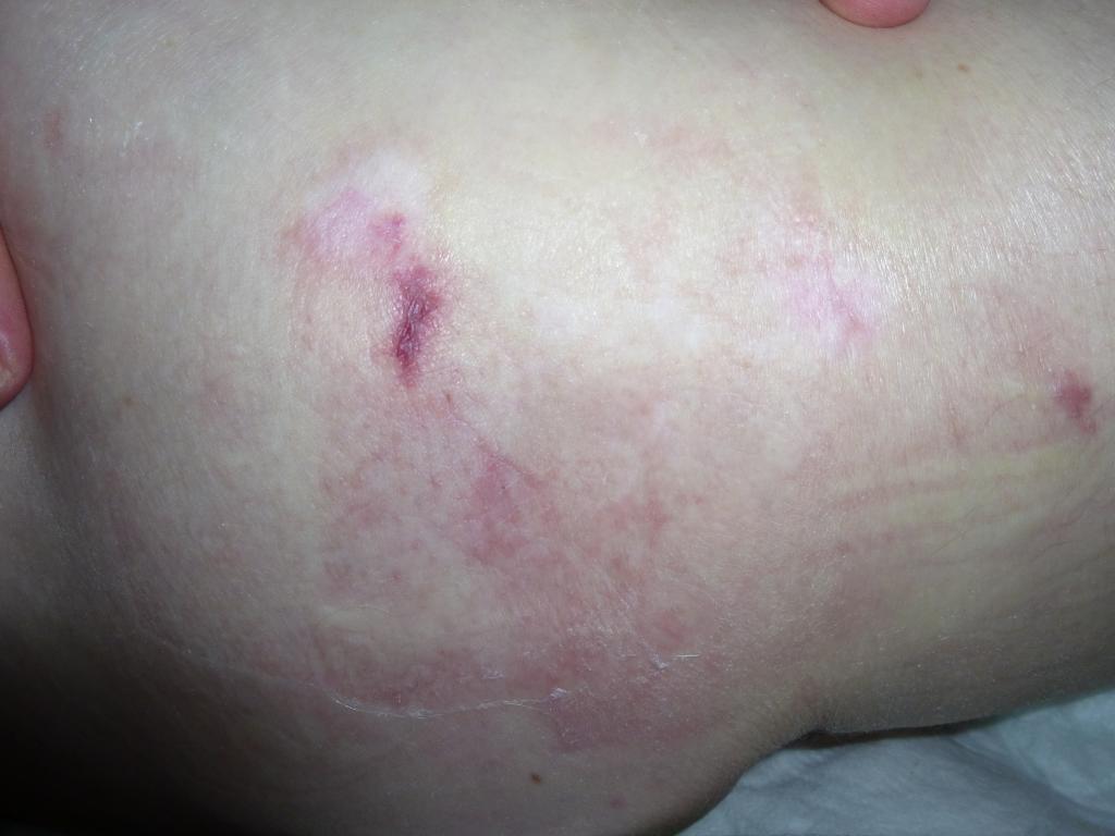 Пролежень. 1 стадия. 1 категория. Pressure ulcer. Пролежень. 1 стадия. 1 категория.