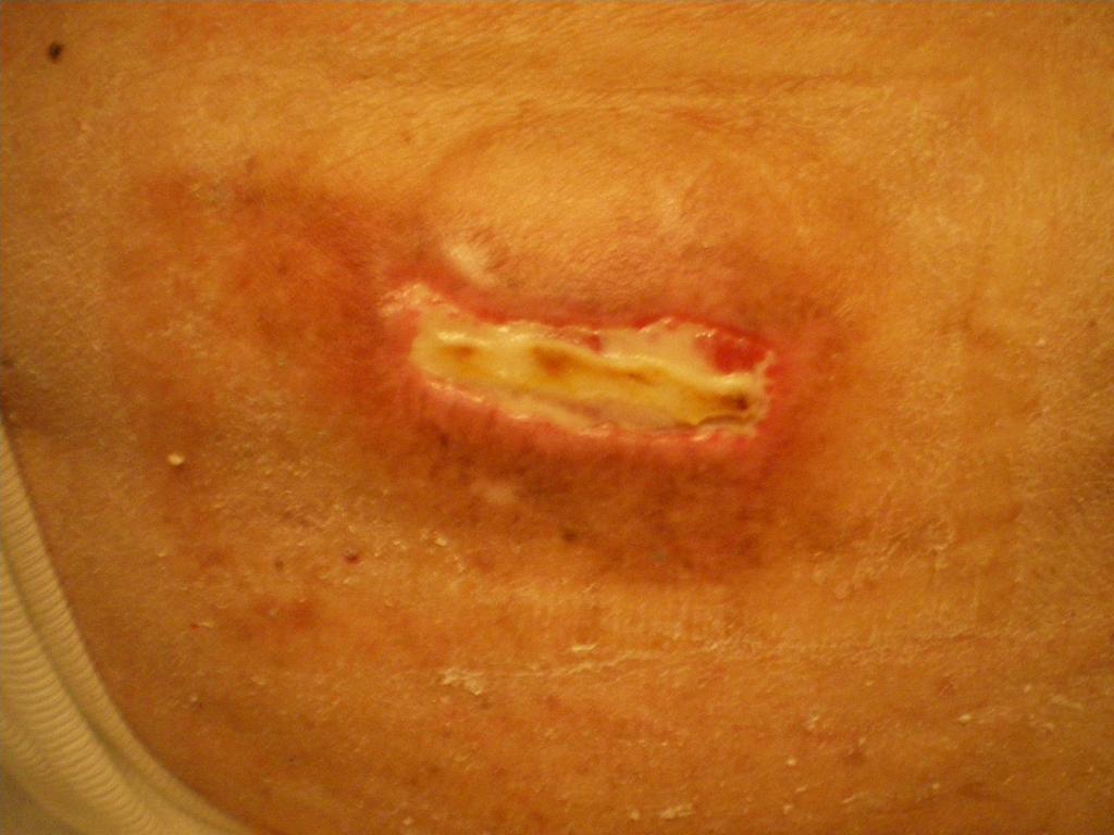 Пролежень. 2 стадия. 2 категория. Pressure ulcer. Пролежень. 2 стадия.
