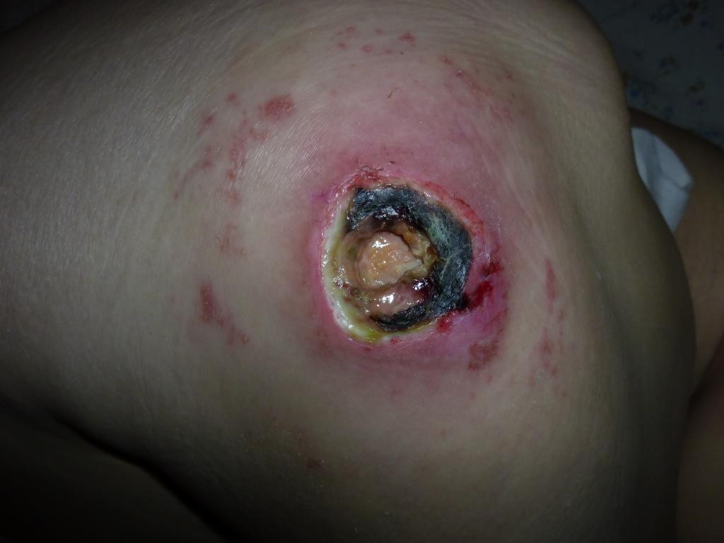 Пролежень. 4 стадия. 4 категория. Pressure ulcer. Пролежень. 4 стадия. 4 категория.