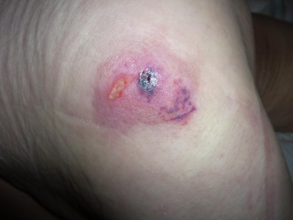 Пролежень. Категория. Подозрение на повреждение глубоких тканей. Pressure ulcer. Пролежень.