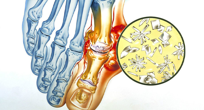 Подагра лечение в домашних условиях народные средства