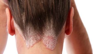 Как лечить ожог на лице от краски