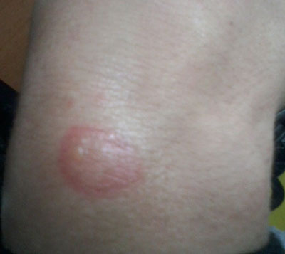 Раздражение кожи, похоже на ожог Пятна в виде ожогов на коже, как симптом крапивницы и следствие аллергической реакции