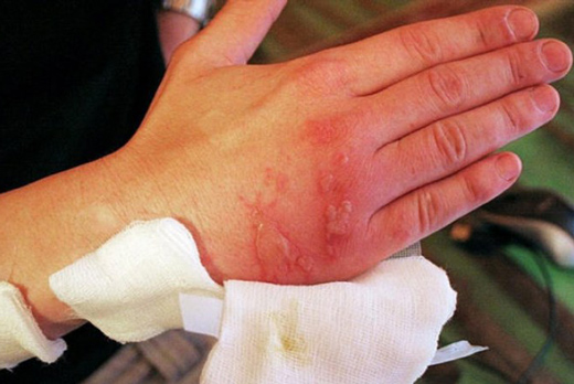 термический ожог руки
