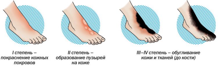 Ожог кипятком когда появляются волдыри